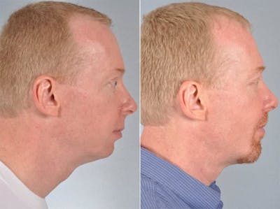 Chin Implant Before & After Gallery - Patient 684309 - Image 2