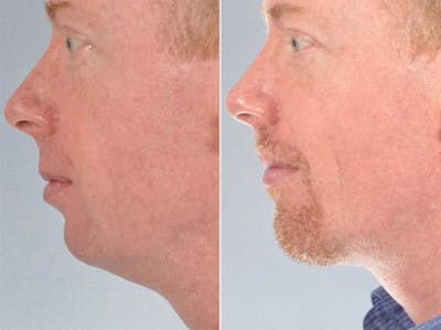 Chin Implant Before & After Gallery - Patient 684309 - Image 3