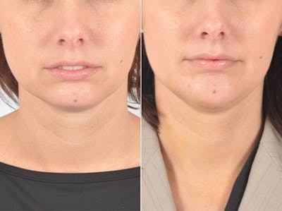 Chin Implant Before & After Gallery - Patient 126874 - Image 1