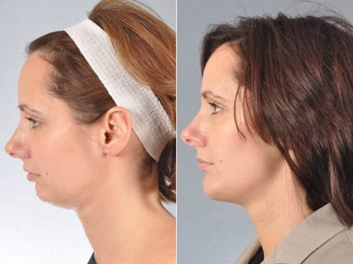 Chin Implant Before & After Gallery - Patient 126874 - Image 3