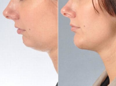 Chin Implant Before & After Gallery - Patient 126874 - Image 4