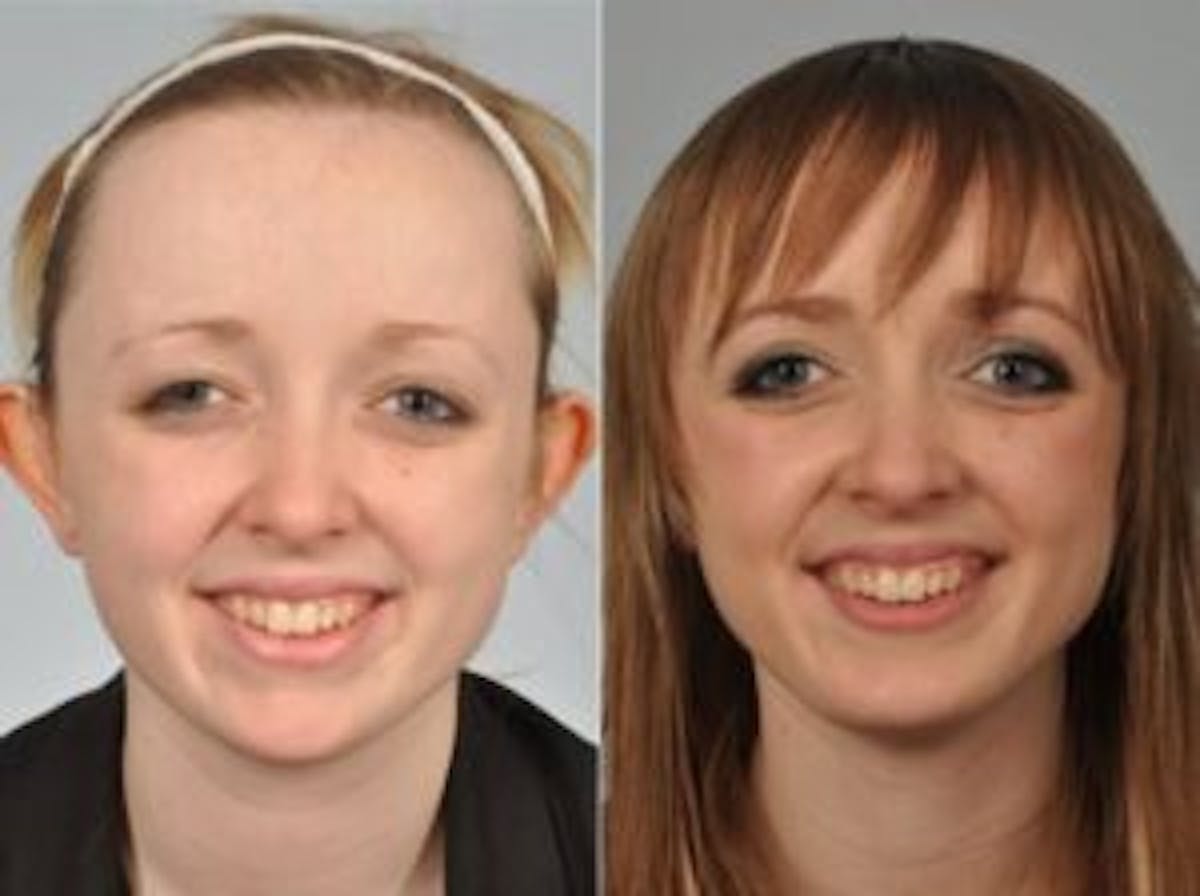 Chin Implant Before & After Gallery - Patient 139098 - Image 1