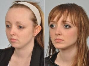 Chin Implant Before & After Gallery - Patient 139098 - Image 1