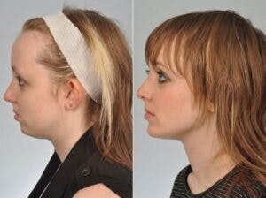 Chin Implant Before & After Gallery - Patient 139098 - Image 3
