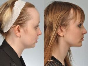Chin Implant Before & After Gallery - Patient 139098 - Image 4