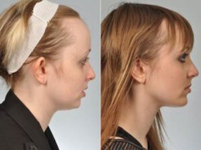 Chin Implant Before & After Gallery - Patient 139098 - Image 4