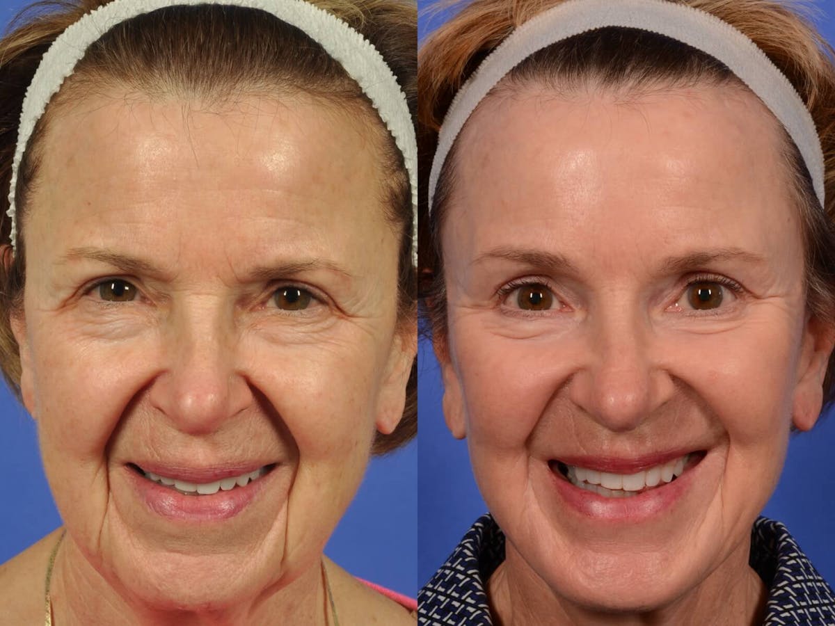 Chin Implant Before & After Gallery - Patient 250155 - Image 1