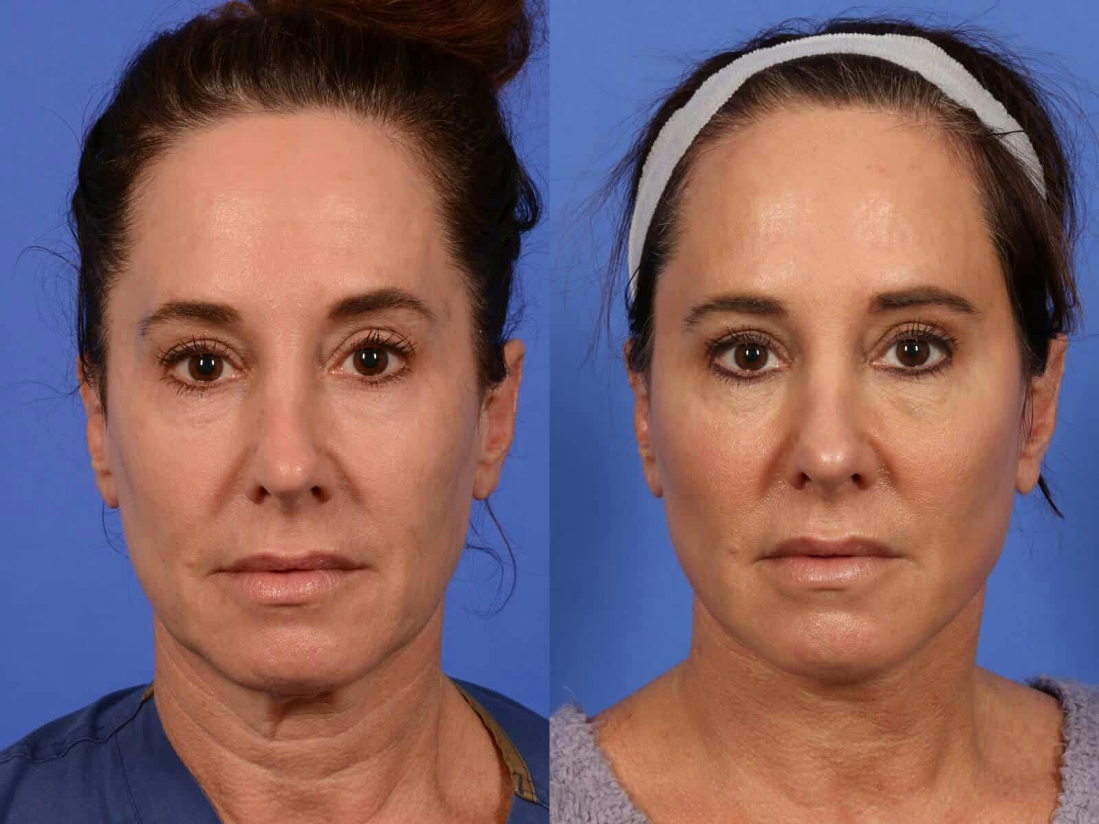 Facelift Before & After Gallery - Patient 388124 - Image 1