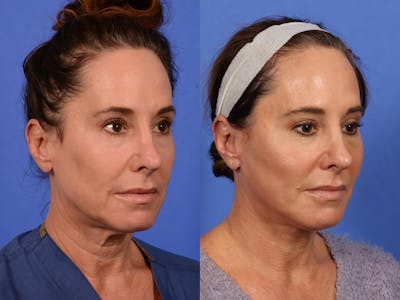 Facelift Before & After Gallery - Patient 388124 - Image 2