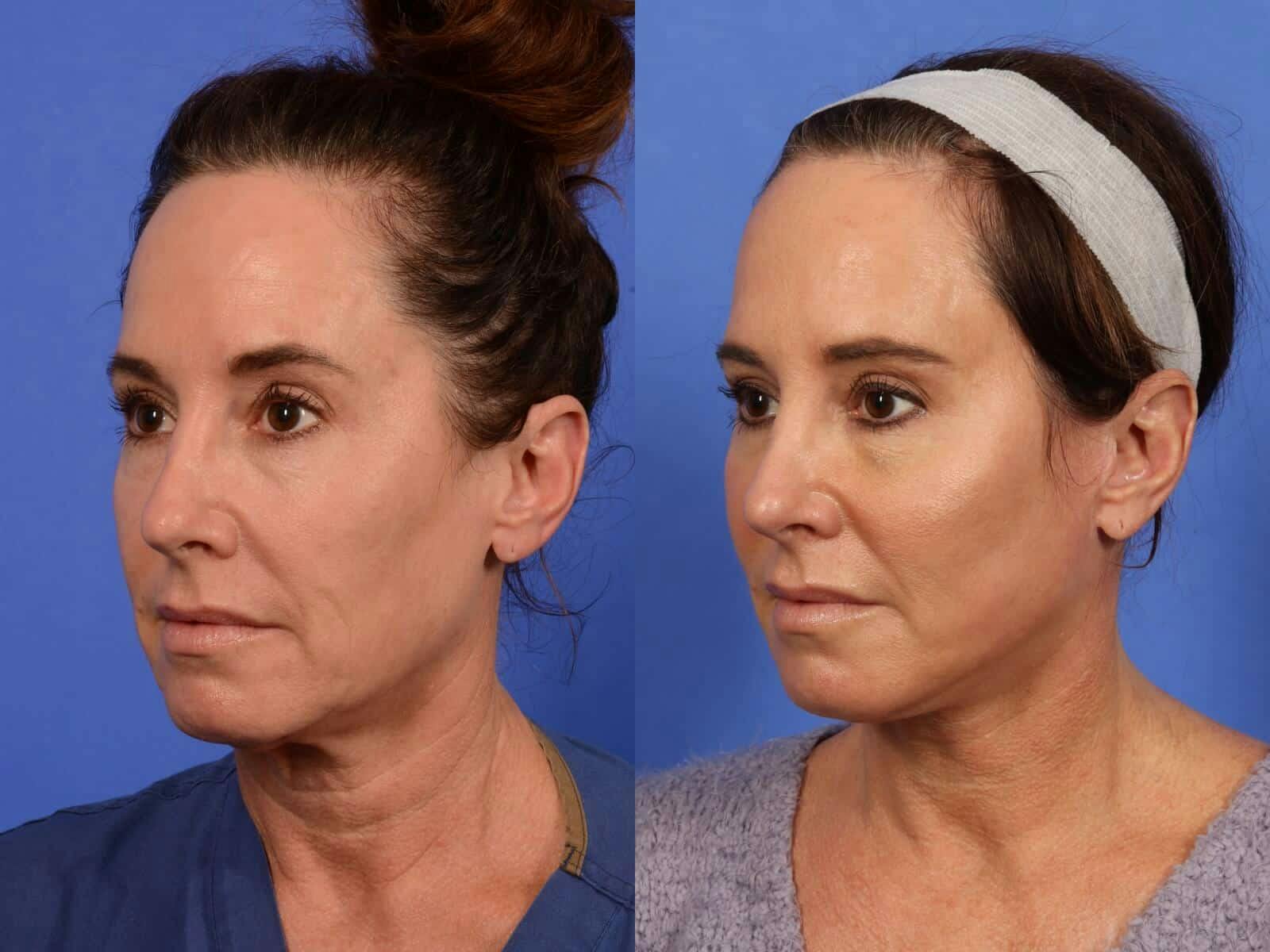 Facelift Before & After Gallery - Patient 388124 - Image 3