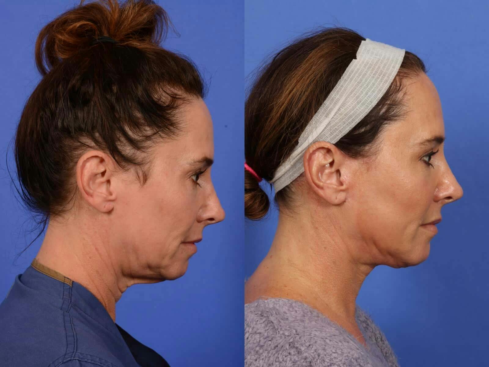 Facelift Before & After Gallery - Patient 388124 - Image 4