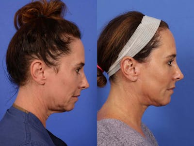 Facelift Before & After Gallery - Patient 388124 - Image 4