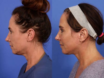 Facelift Before & After Gallery - Patient 388124 - Image 5
