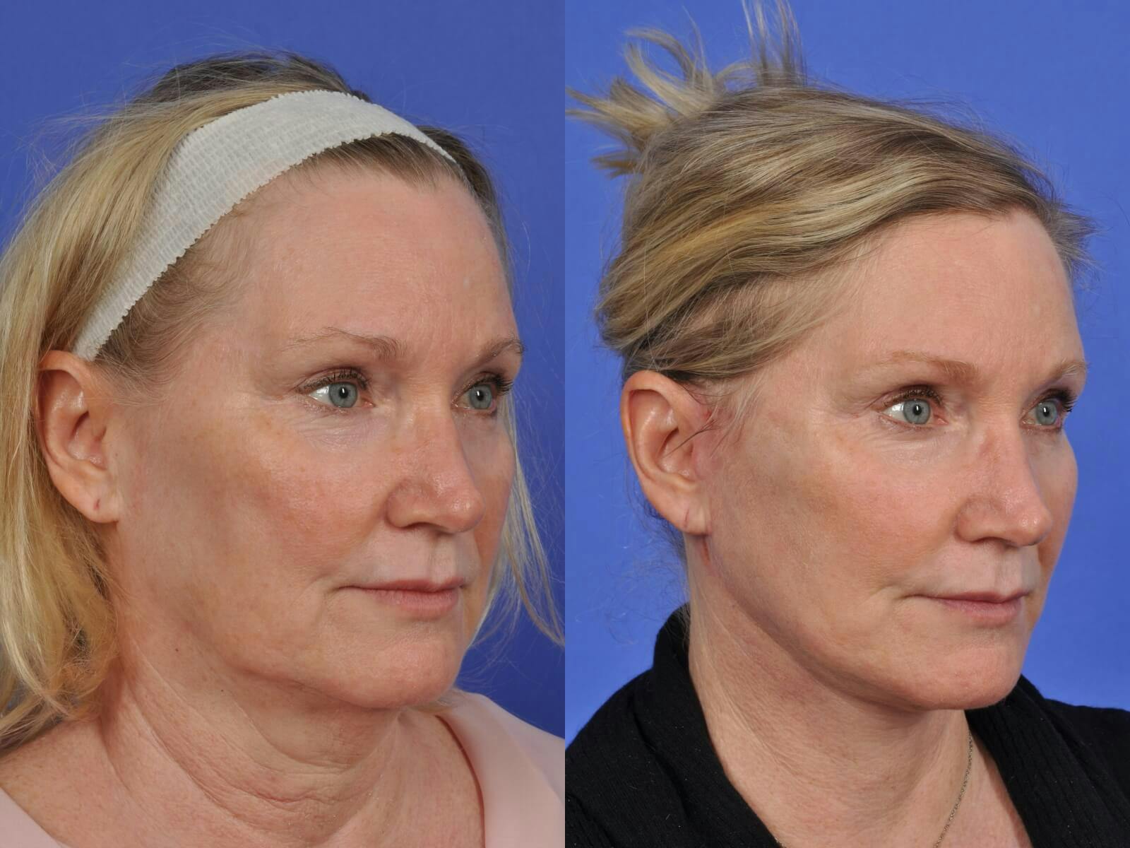 Facelift Before & After Gallery - Patient 245583 - Image 2
