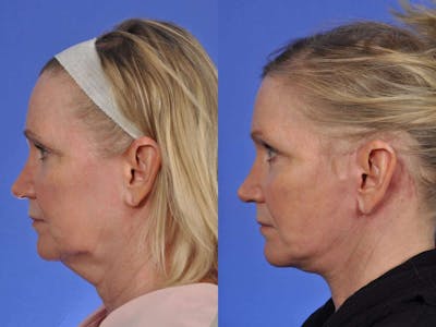 Facelift Before & After Gallery - Patient 245583 - Image 4