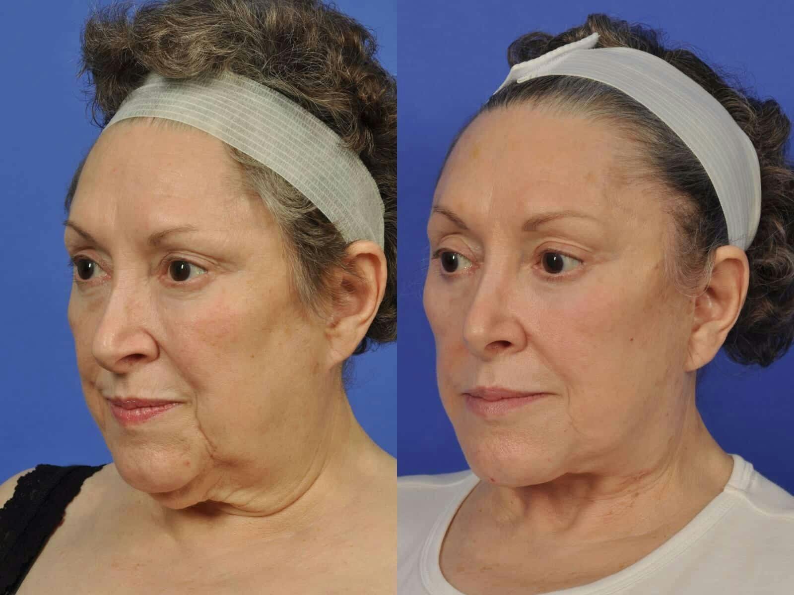 Facelift Before & After Gallery - Patient 408322 - Image 2