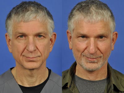 Facelift Before & After Gallery - Patient 106897 - Image 1