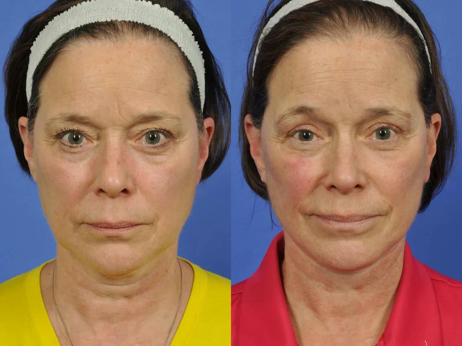 Facelift Before & After Gallery - Patient 107385 - Image 1