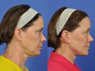 Facelift Before & After Gallery - Patient 107385 - Image 4
