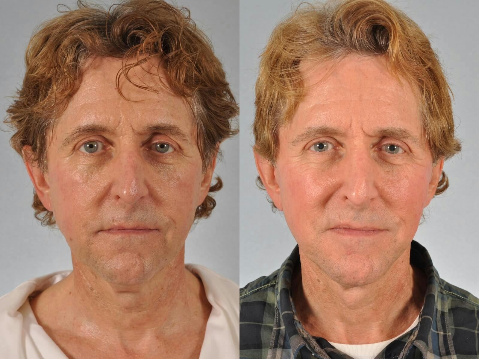 Facelift Before & After Gallery - Patient 464137 - Image 1