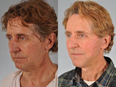 Facelift Before & After Gallery - Patient 464137 - Image 2
