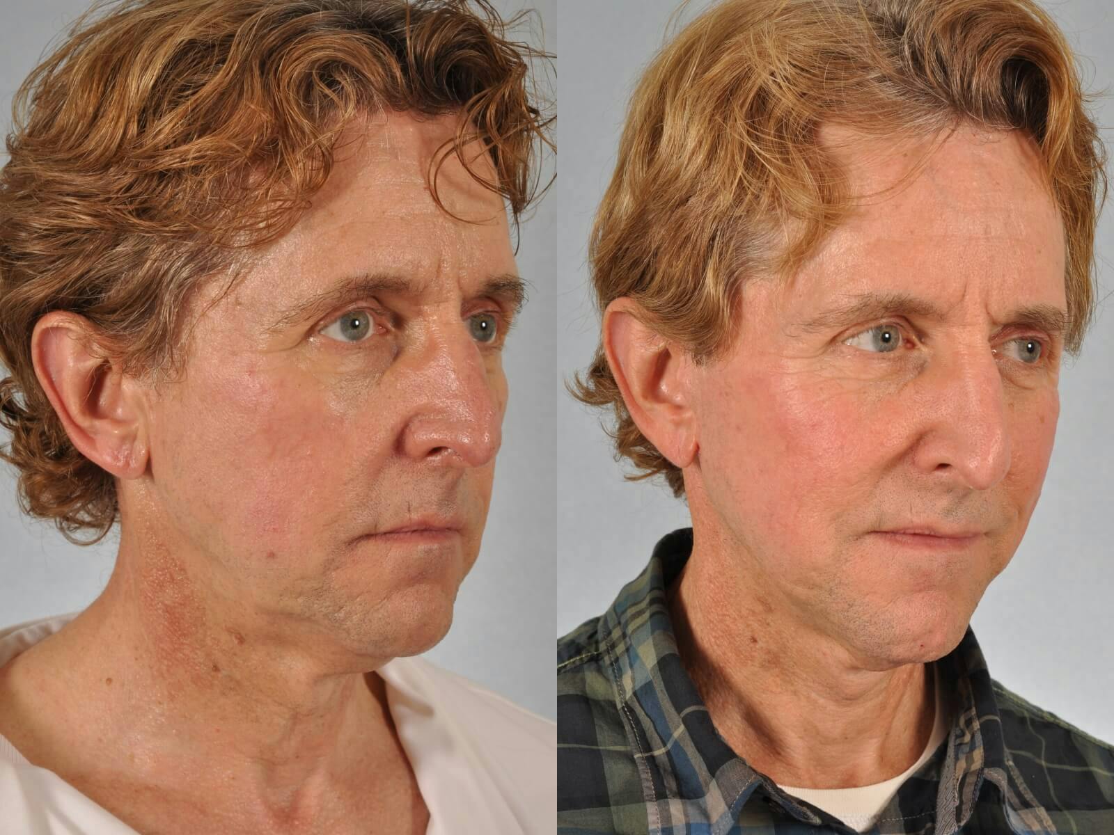 Facelift Before & After Gallery - Patient 464137 - Image 3