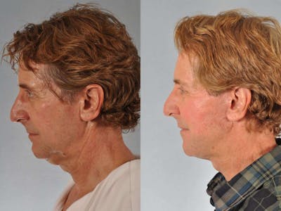 Facelift Before & After Gallery - Patient 464137 - Image 4