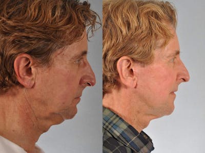 Facelift Before & After Gallery - Patient 464137 - Image 5