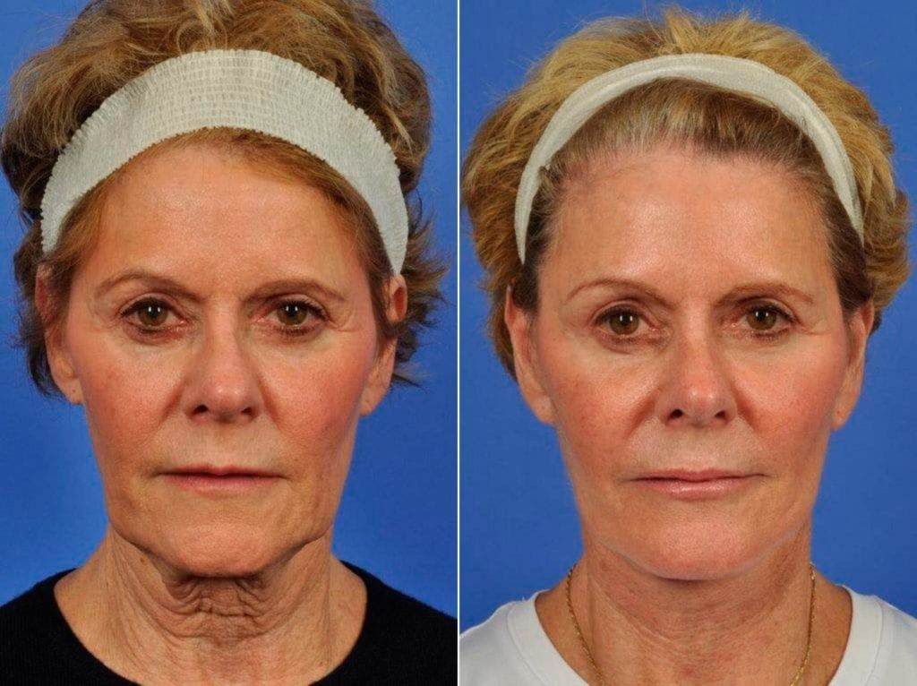 Facelift Before & After Gallery - Patient 384889 - Image 1