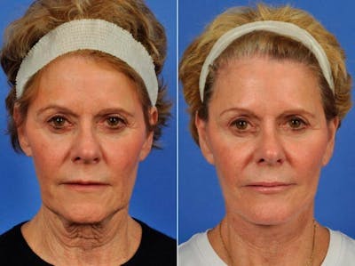 Facelift Before & After Gallery - Patient 384889 - Image 1