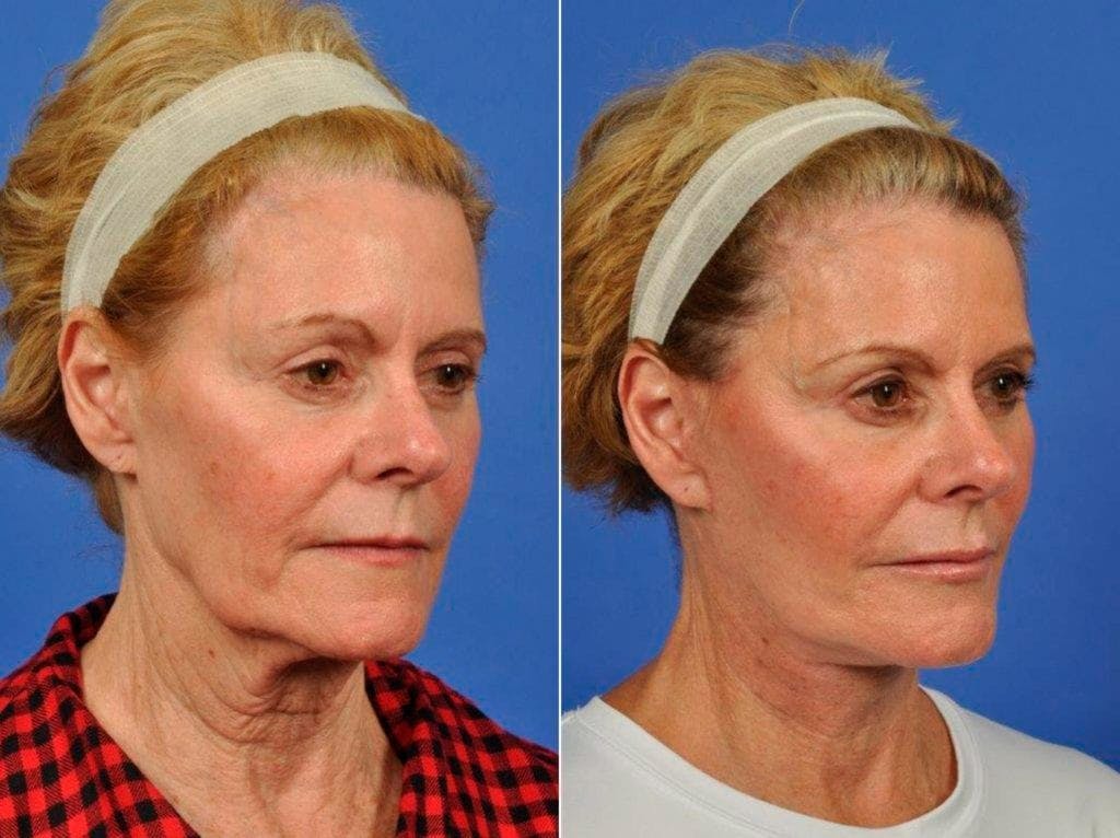 Facelift Before & After Gallery - Patient 384889 - Image 2