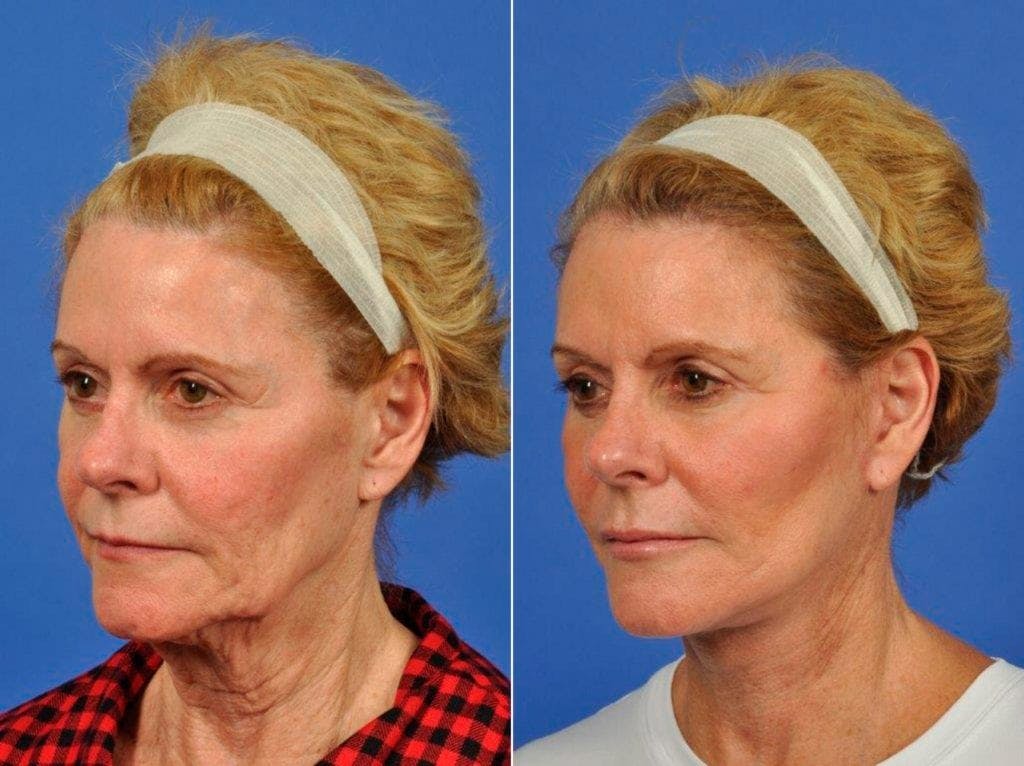 Facelift Before & After Gallery - Patient 384889 - Image 3