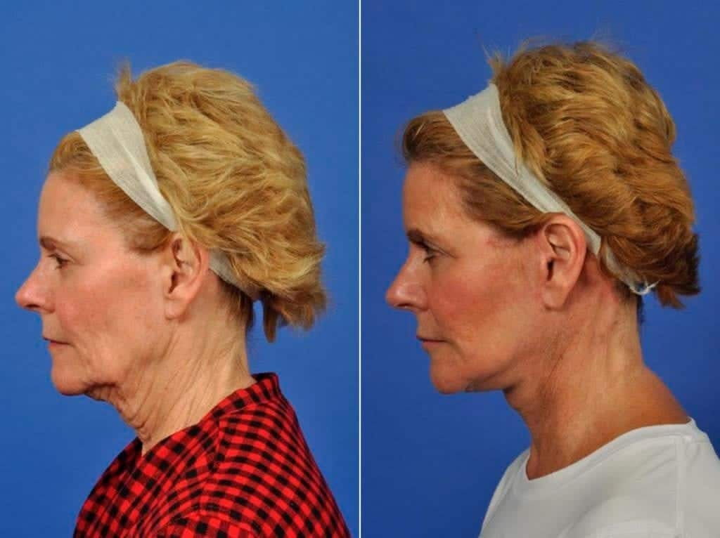 Facelift Before & After Gallery - Patient 384889 - Image 4