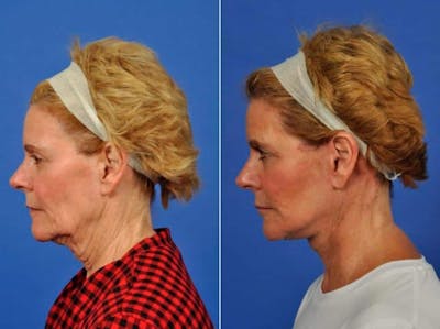 Facelift Before & After Gallery - Patient 384889 - Image 4
