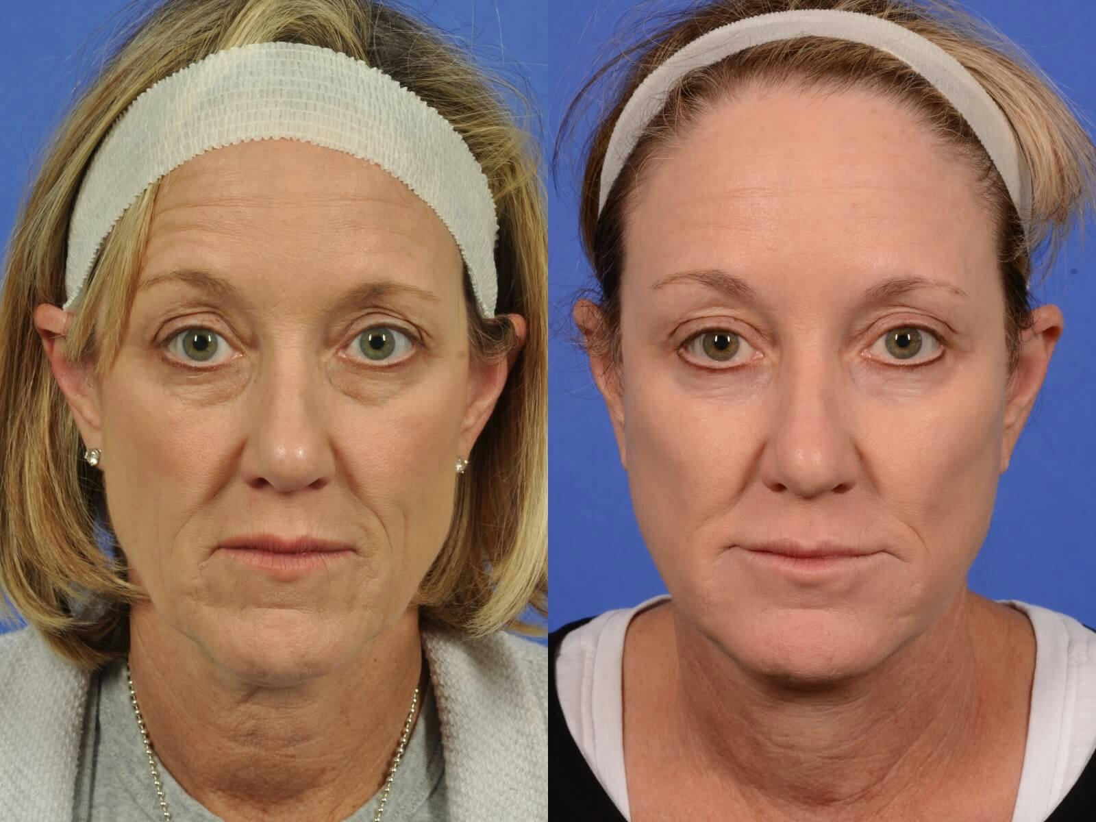 Facelift Before & After Gallery - Patient 129197 - Image 1