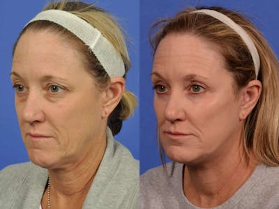 Facelift Before & After Gallery - Patient 129197 - Image 3