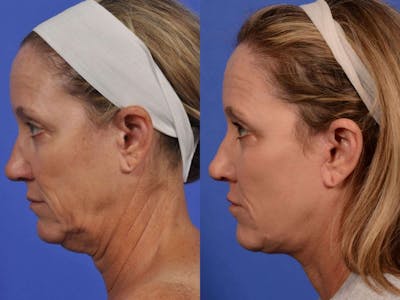 Facelift Before & After Gallery - Patient 129197 - Image 4
