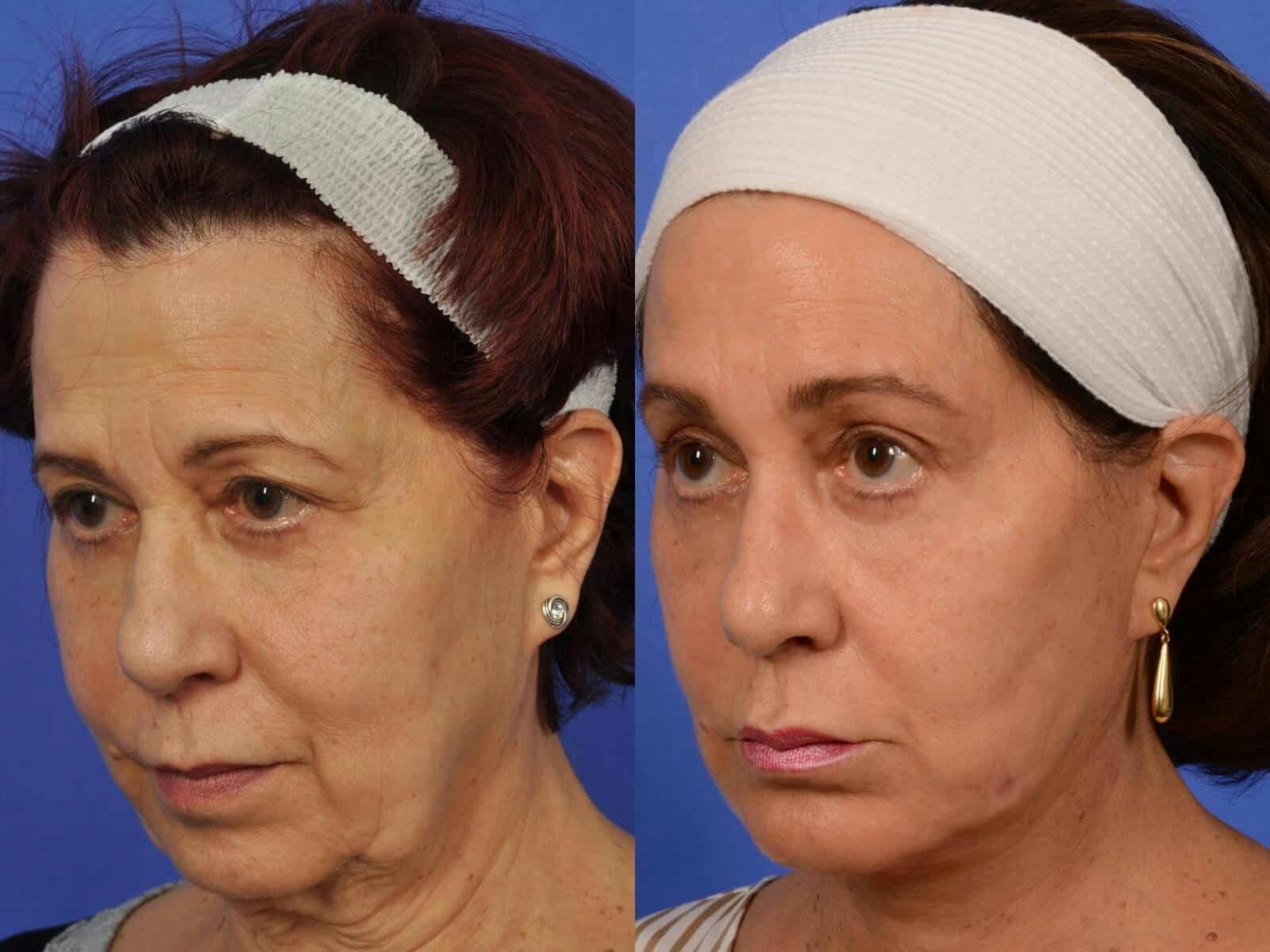 Facelift Before & After Gallery - Patient 441399 - Image 2