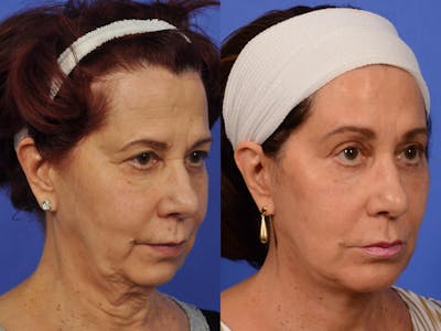 Facelift Before & After Gallery - Patient 441399 - Image 3