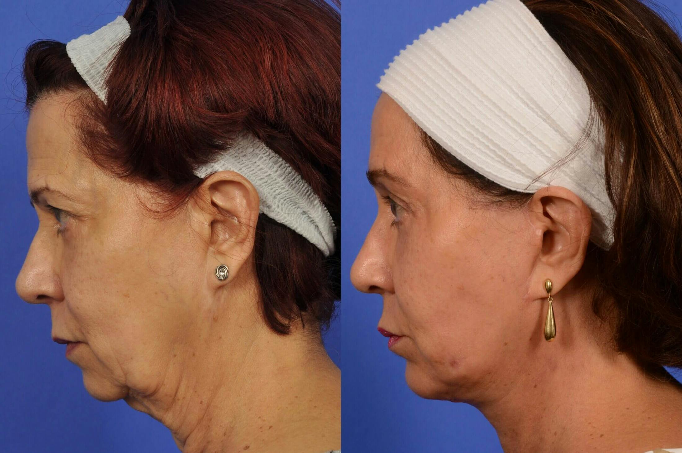 Facelift Before & After Gallery - Patient 441399 - Image 5
