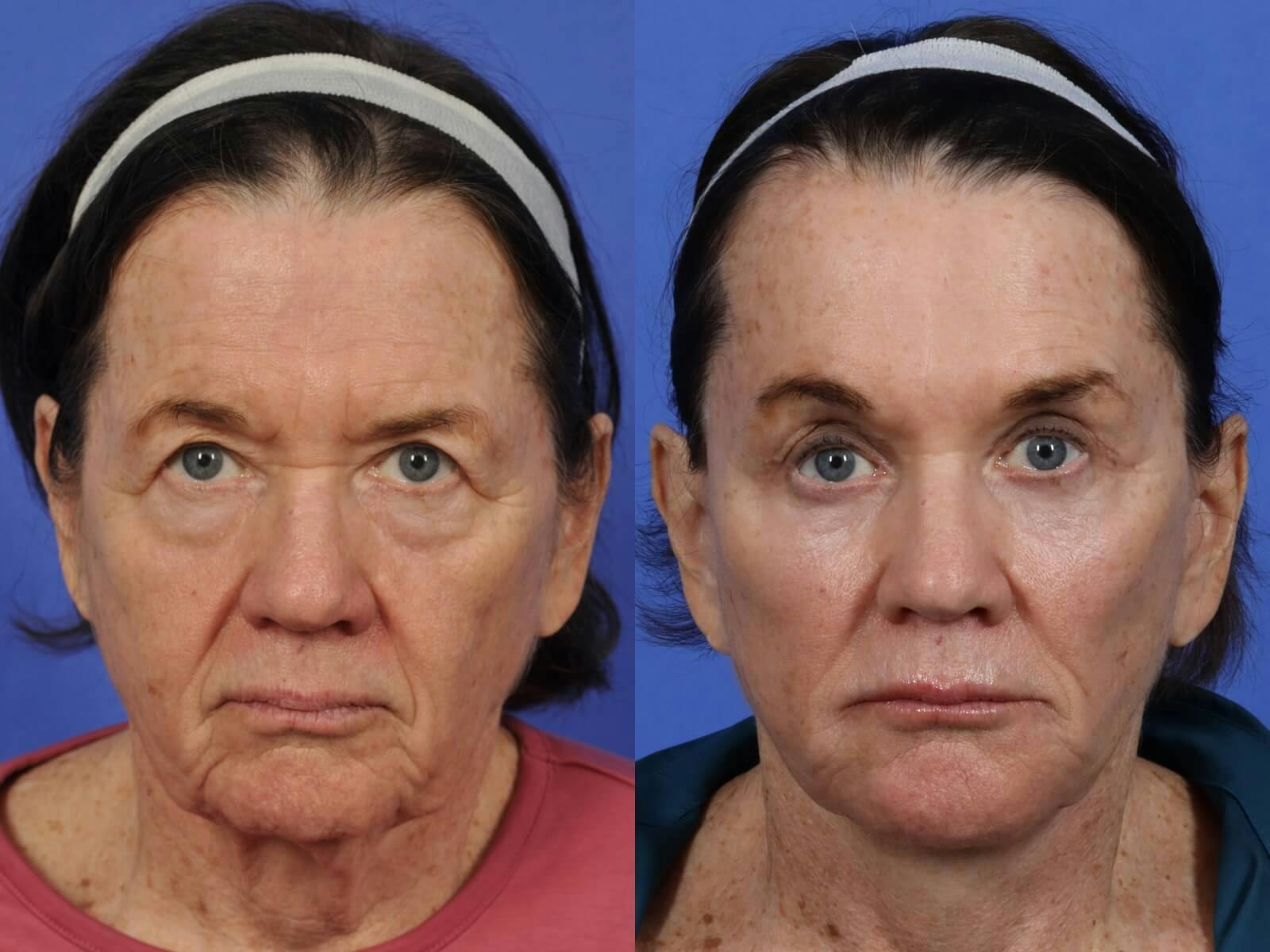 Facelift Before & After Gallery - Patient 324916 - Image 1