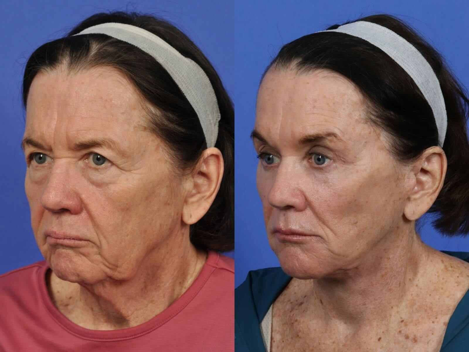 Facelift Before & After Gallery - Patient 324916 - Image 2