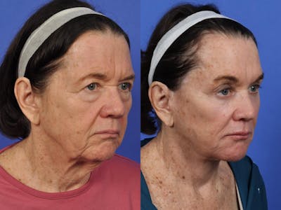 Facelift Before & After Gallery - Patient 324916 - Image 3