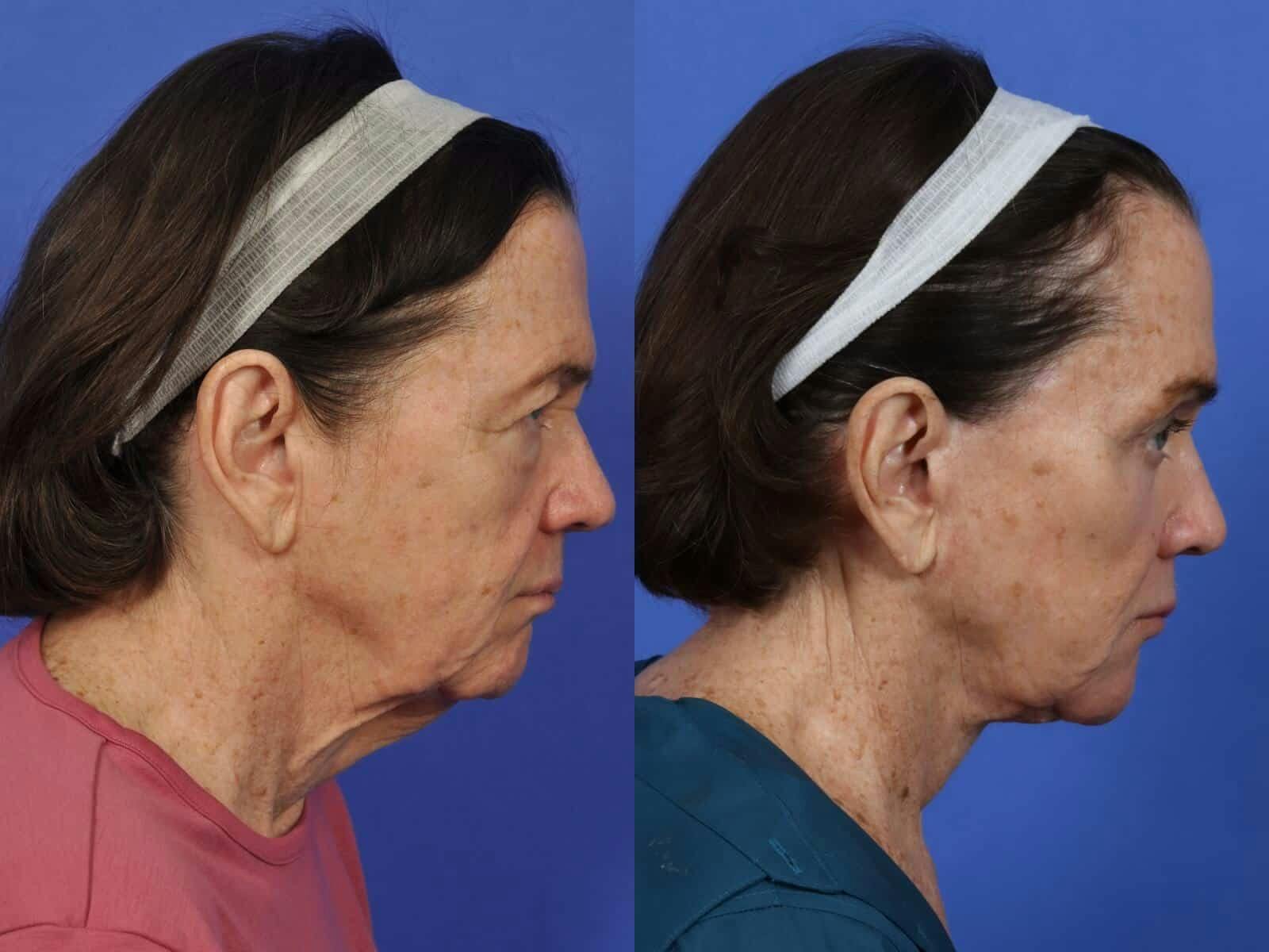 Facelift Before & After Gallery - Patient 324916 - Image 4