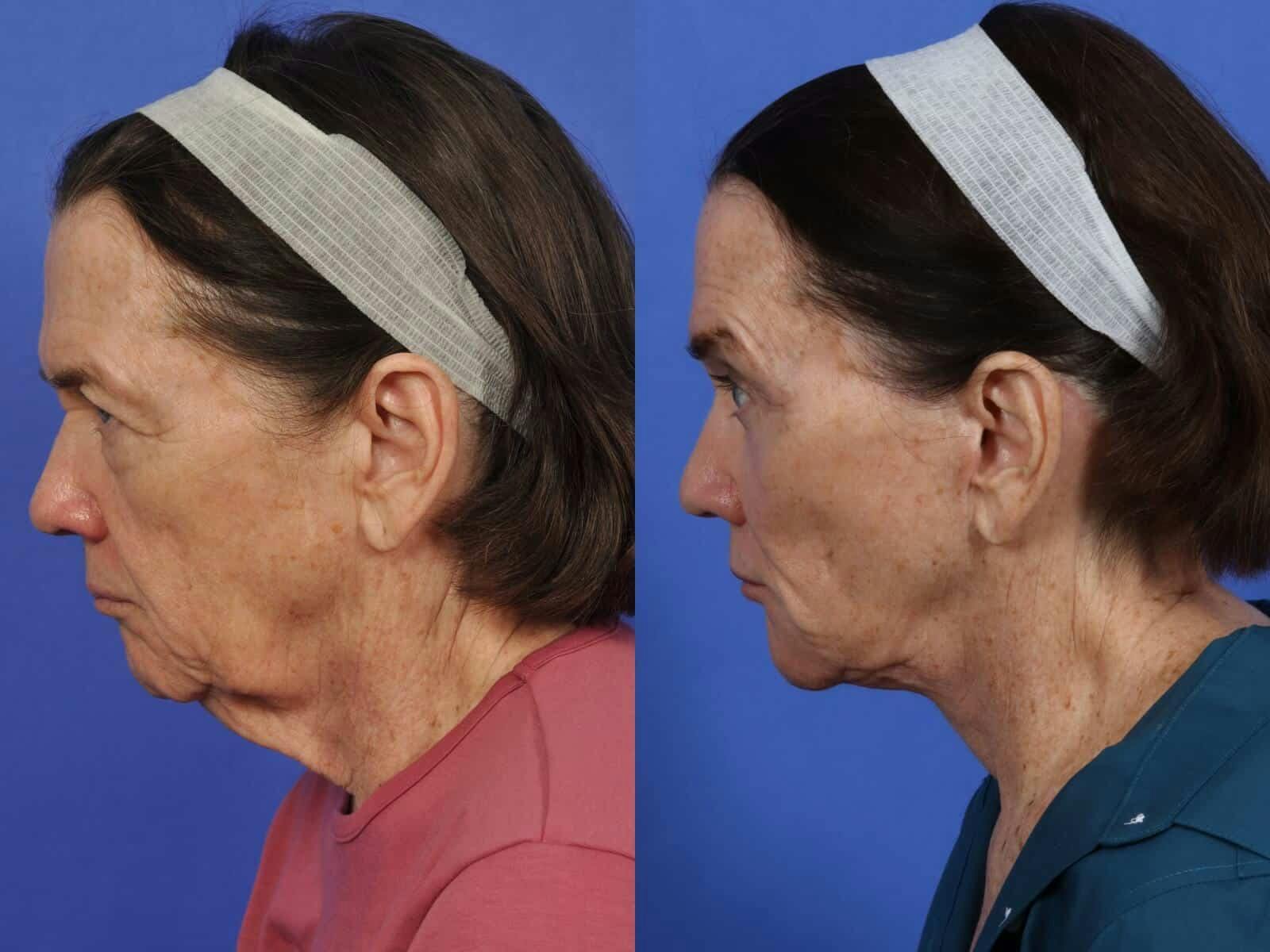 Facelift Before & After Gallery - Patient 324916 - Image 5