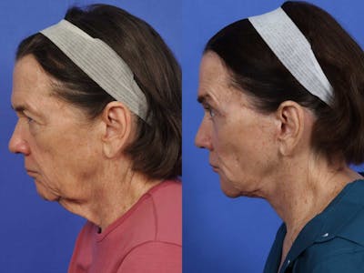 Facelift Before & After Gallery - Patient 324916 - Image 5
