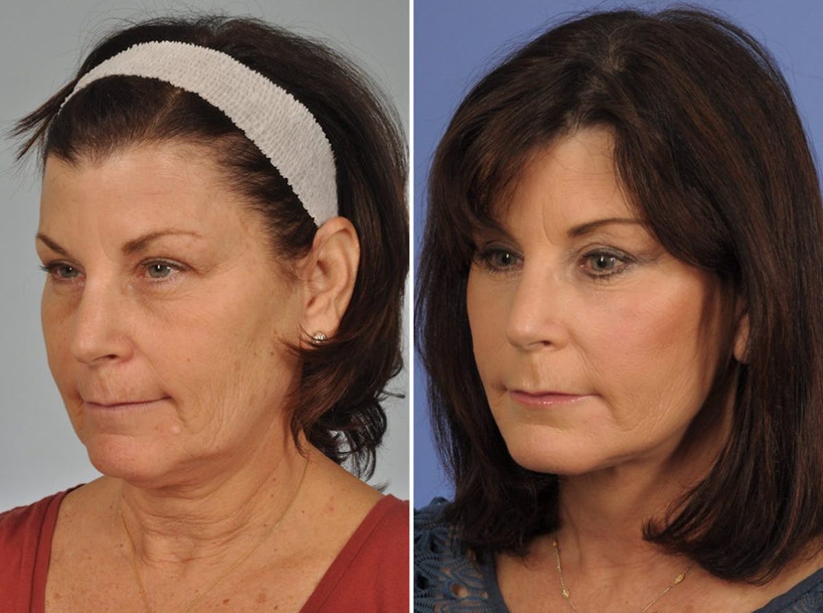 Facelift Before & After Gallery - Patient 123794 - Image 2