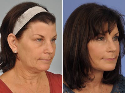 Facelift Before & After Gallery - Patient 123794 - Image 3