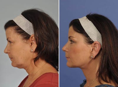 Facelift Before & After Gallery - Patient 123794 - Image 4