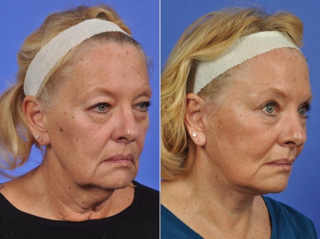 Facelift Before & After Gallery - Patient 418266 - Image 2